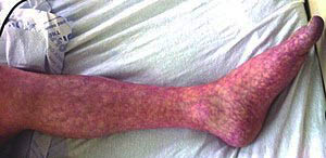 Mottled Skin on Leg